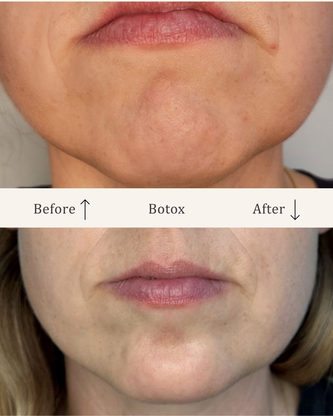 Botox-hage-visage-studio-kosmetisk-klinik-odense.jpg