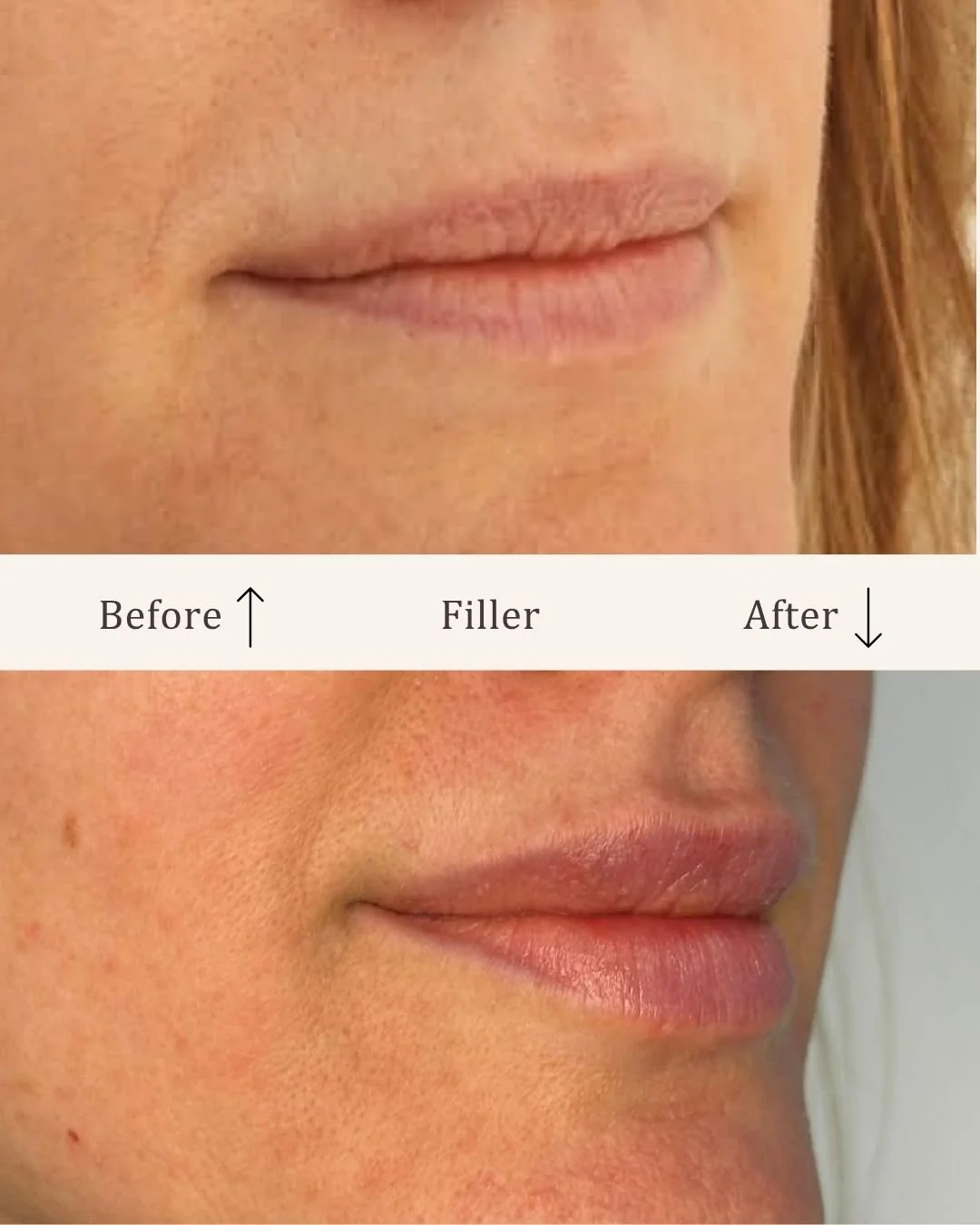Filler-lipfiller-visage-studio-kosmetisk-klinik-odense-14.jpg