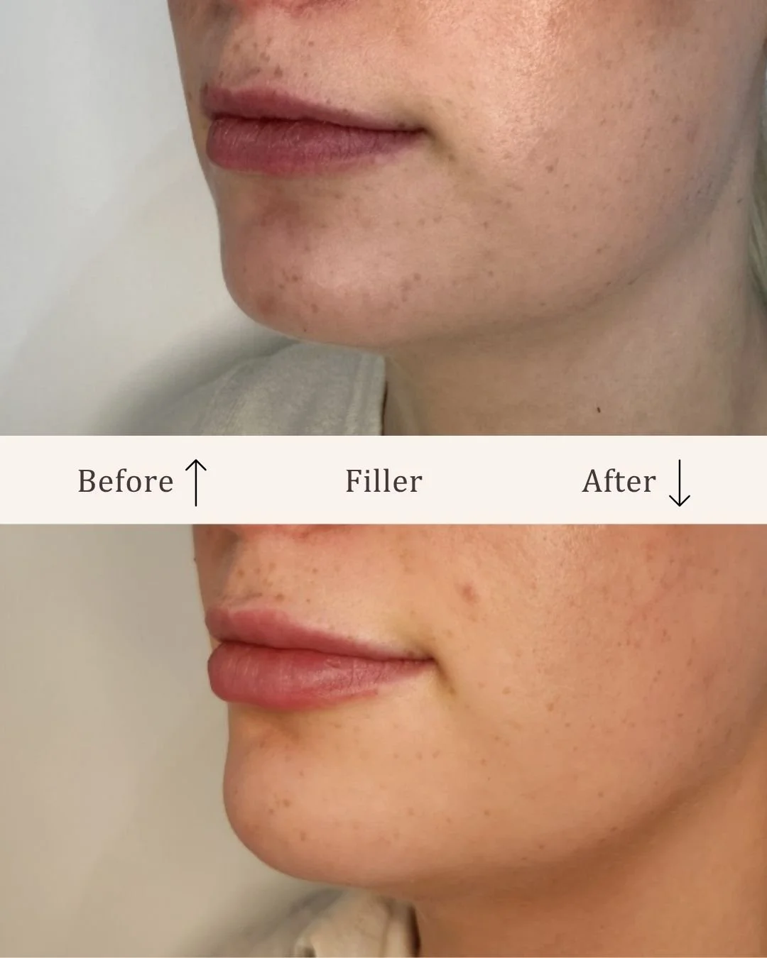 Filler-lipfiller-visage-studio-kosmetisk-klinik-odense.jpg