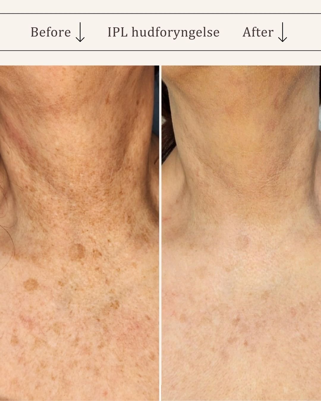 IPL-hud-foryngende-visage-studio-kosmetisk-klinik-odense-2.jpg