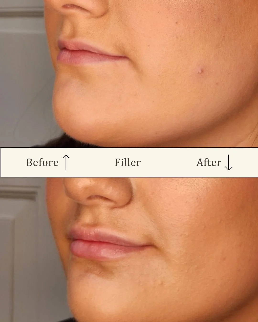 Lipfiller