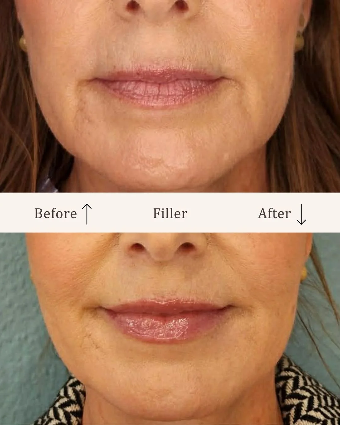 Filler-lipfiller-visage-studio-kosmetisk-klinik-odense-17.jpg