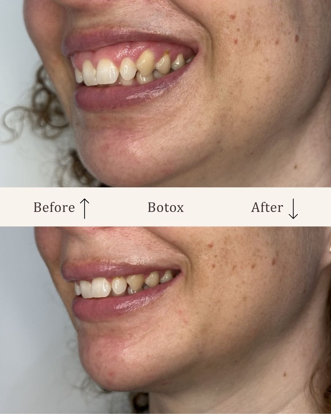 Botox-gummysmile-visage-studio-kosmetisk-klinik-odense-5.jpg