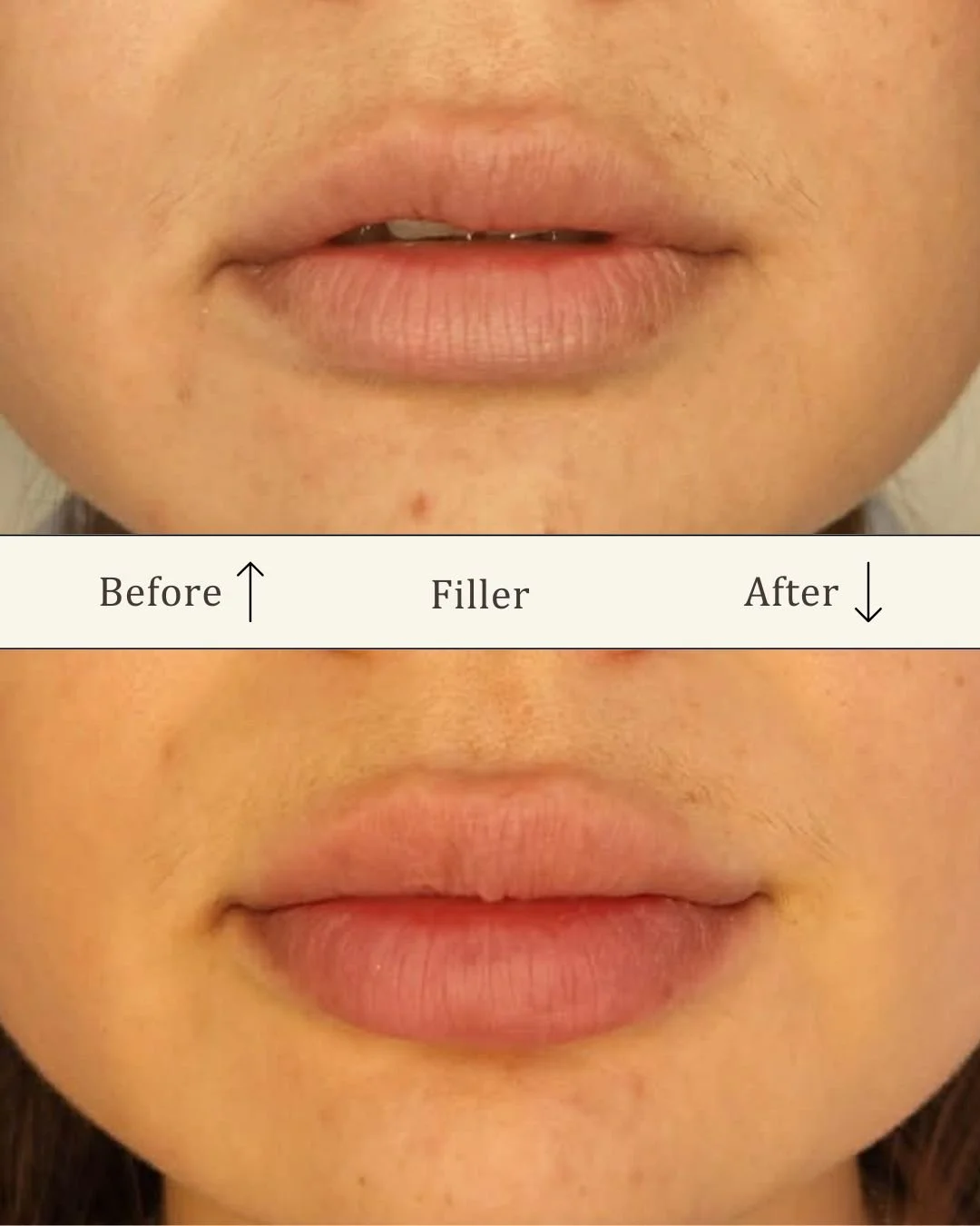 filler-laeber-odense-for-efter-visage-studio.jpg