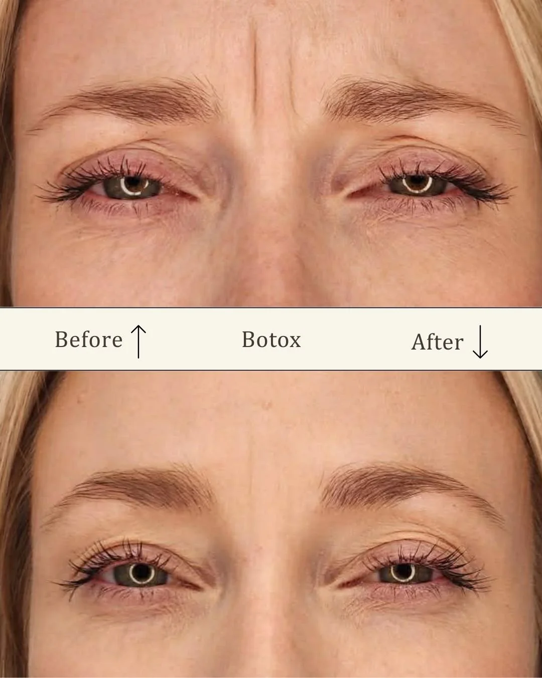 Botox bekymringsrynke 3.jpg