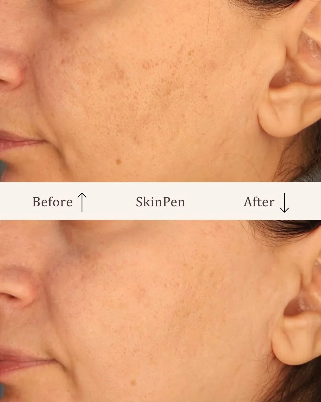 Skinpen-microneedling-visage-studio-kosmetisk-klinik-odense.jpg