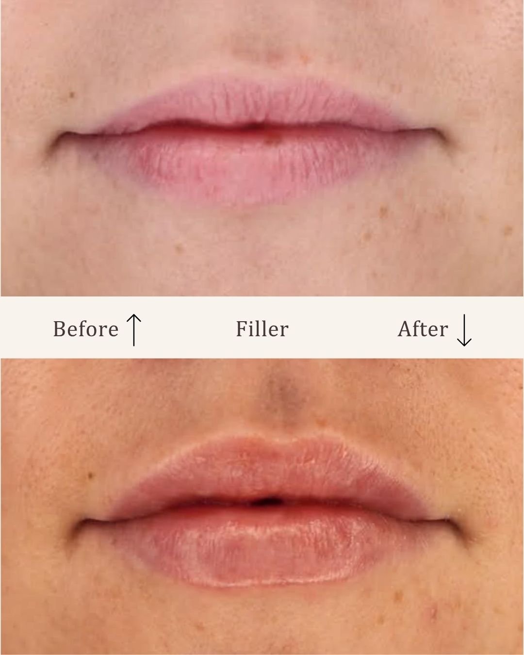 Filler-lipfiller-visage-studio-kosmetisk-klinik-odense-7.jpg