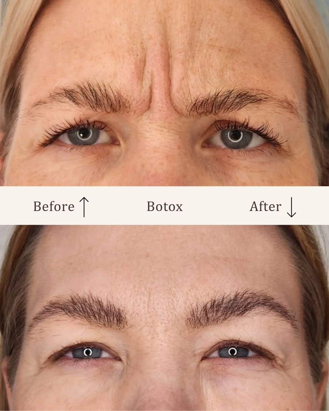 Botox-glabella-visage-studio-kosmetisk-klinik-odense-4.jpg