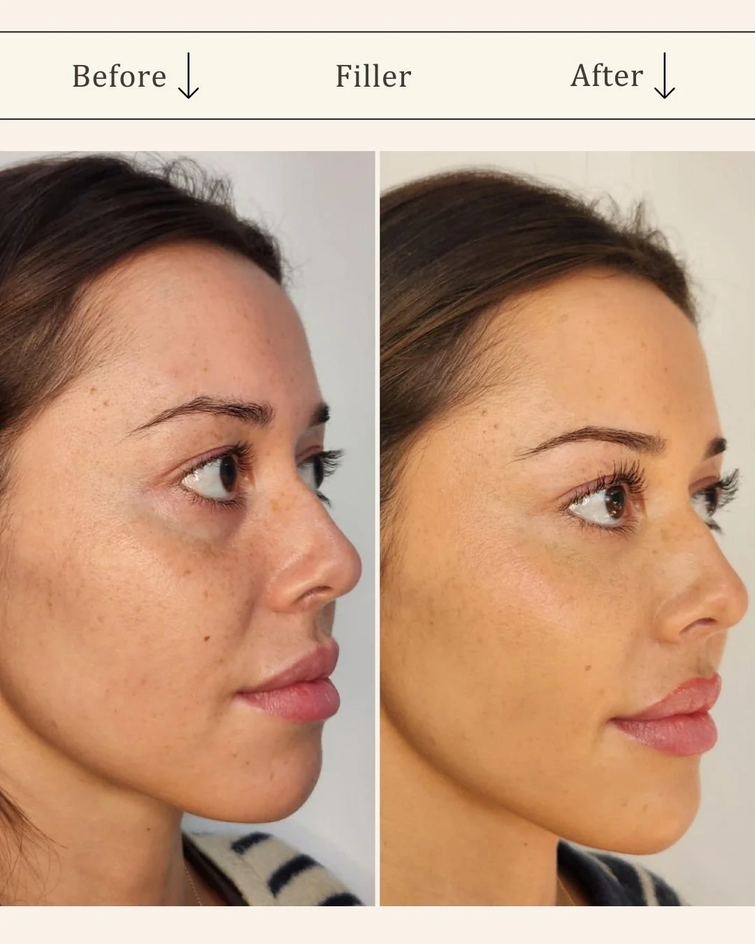 Filler under øjnene - tear trough
Filler i indre kind