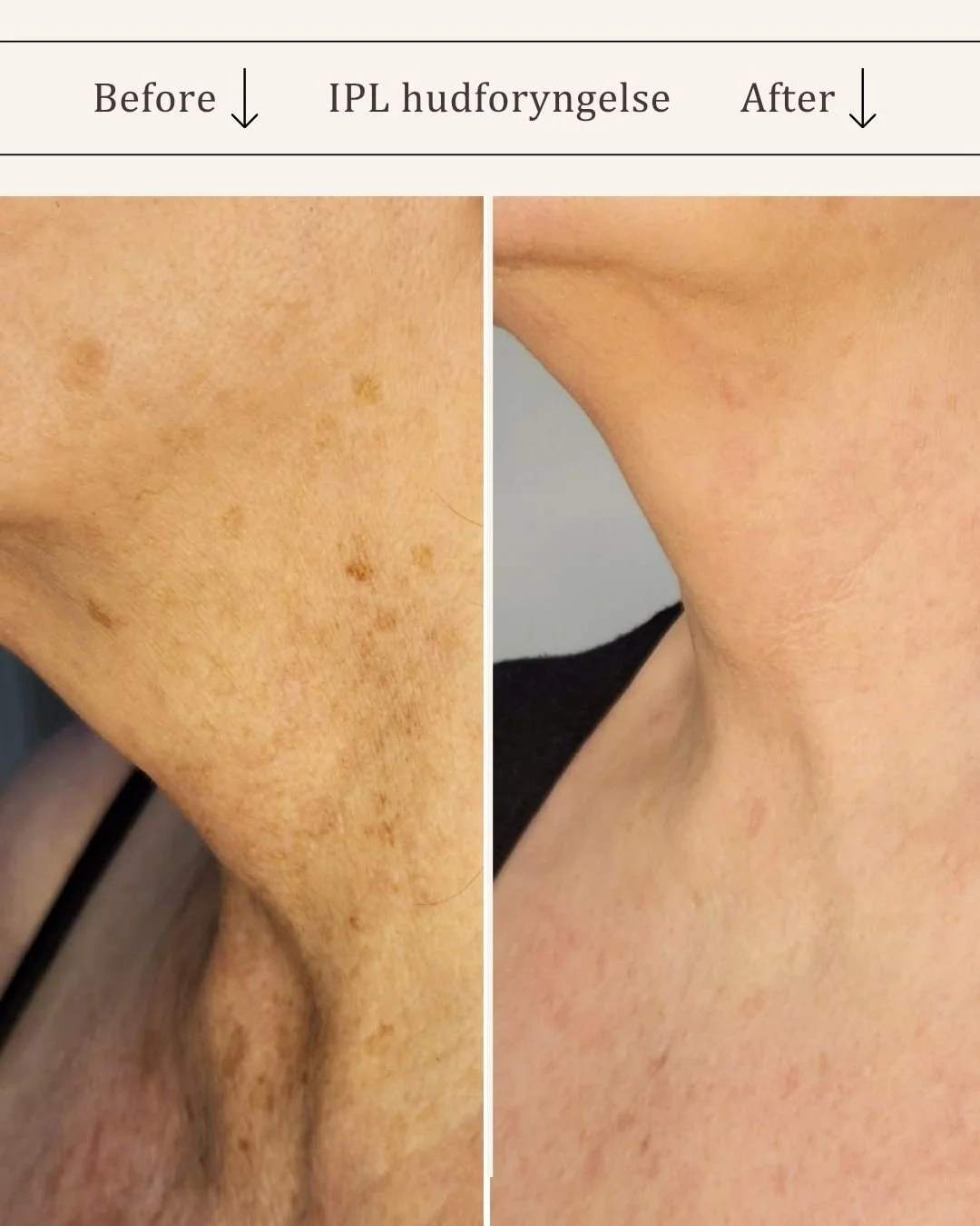 IPL-hud-foryngende-visage-studio-kosmetisk-klinik-odense-3.jpg