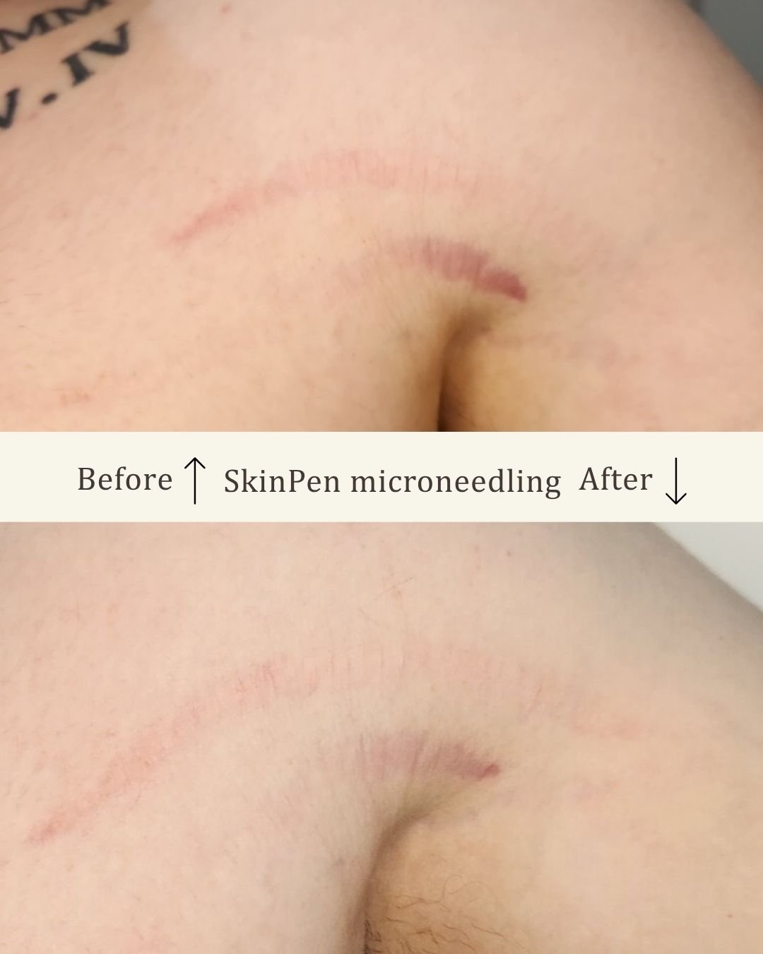 Skinpen-microneedling-ar-visage-studio-kosmetisk-klinik-odense.jpg