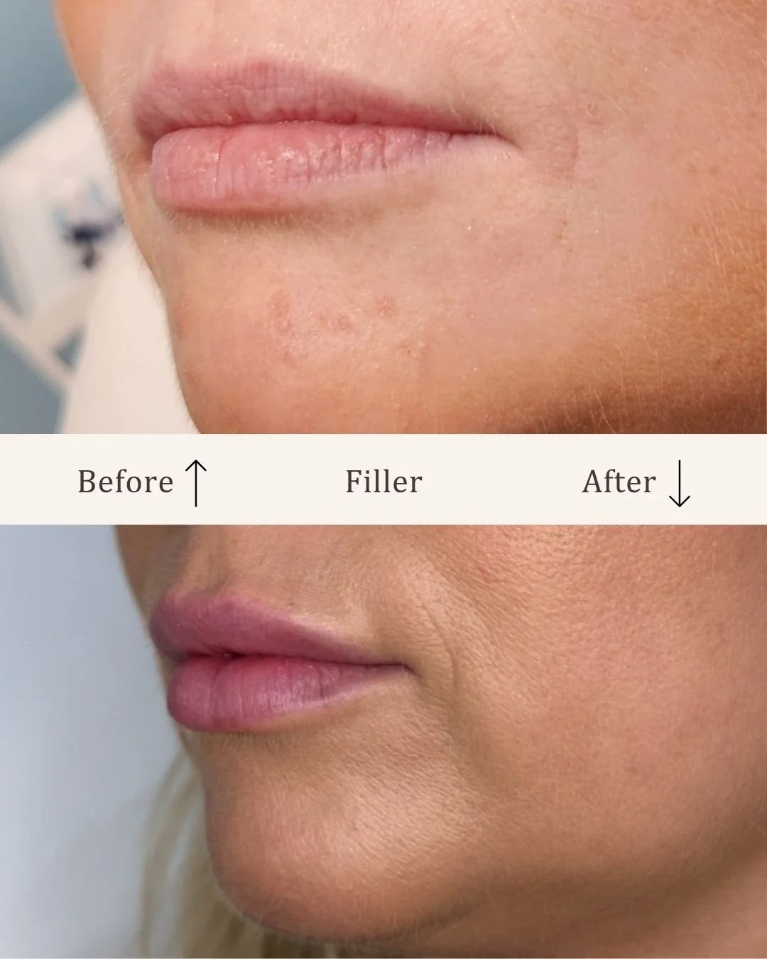 Filler-lipfiller-visage-studio-kosmetisk-klinik-odense-4.jpg