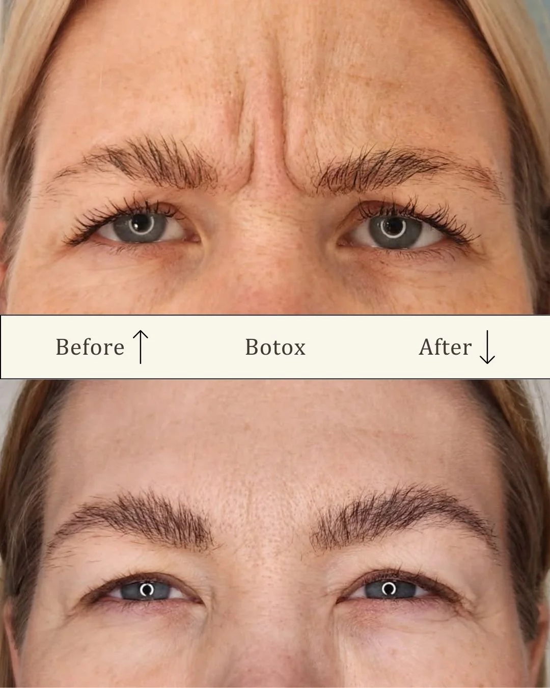 Botox bekymringsrynke.jpg