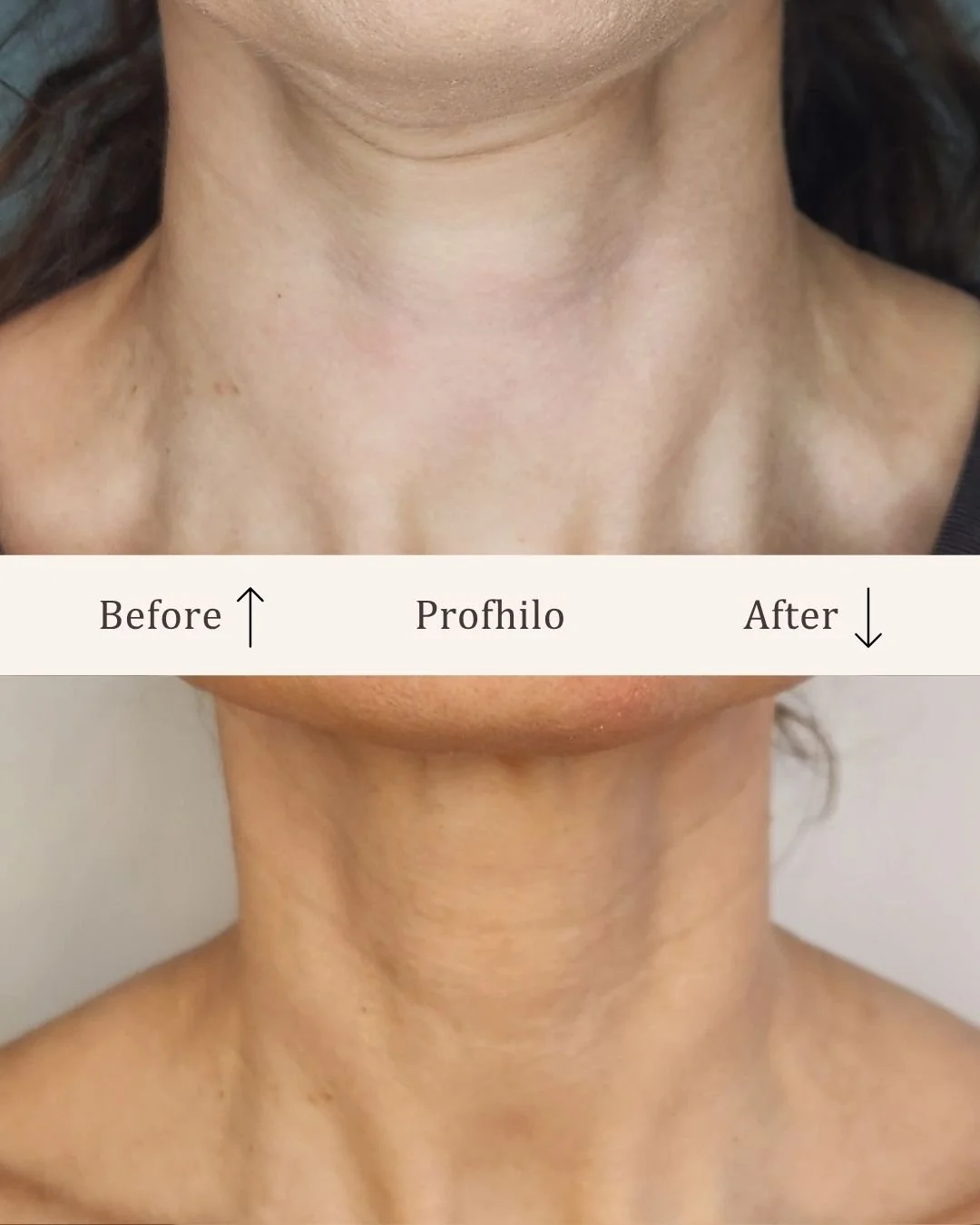 Profhilo-visage-studio-kosmetisk-klinik-odense.jpg