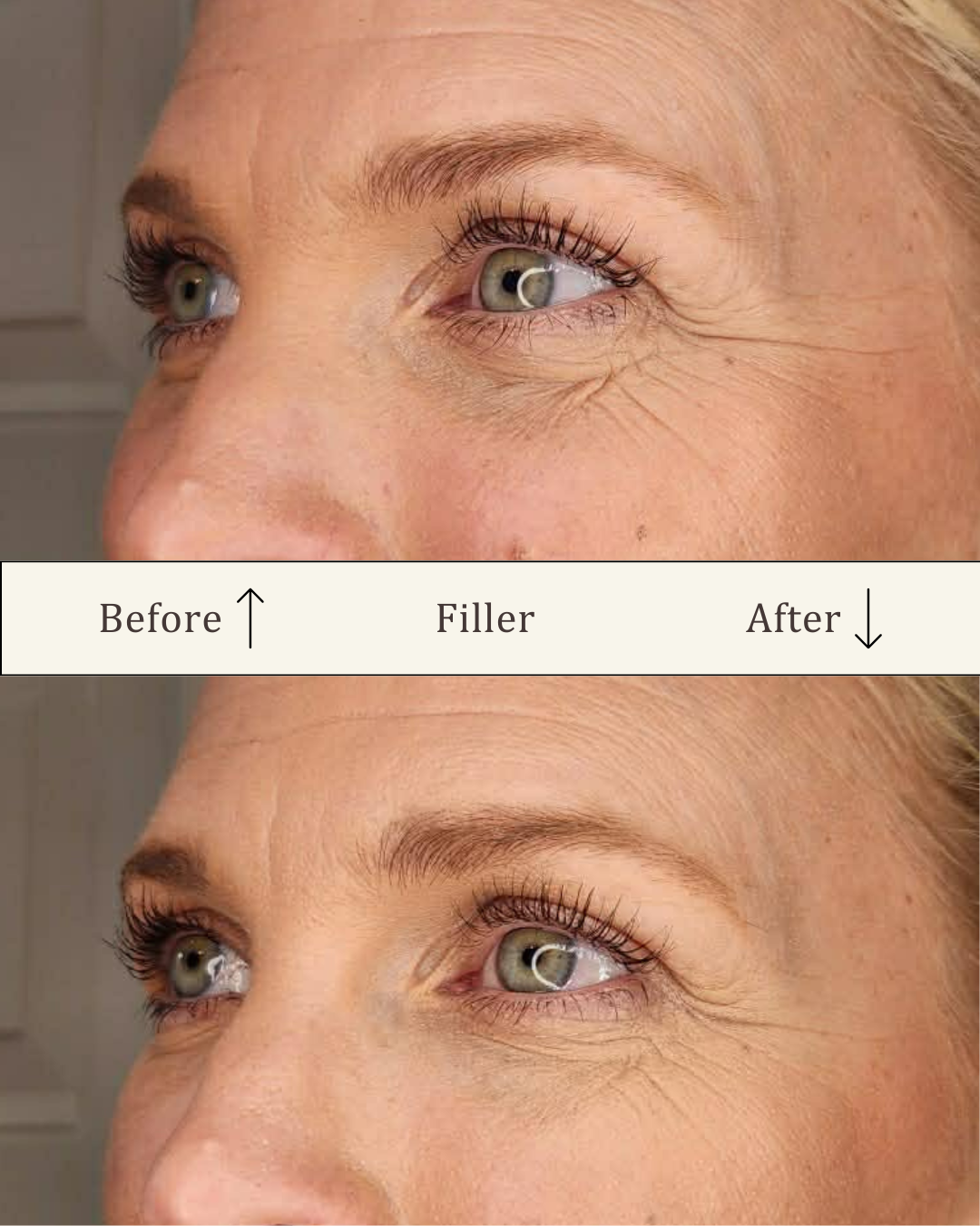 Filler under øjnene - tear trough