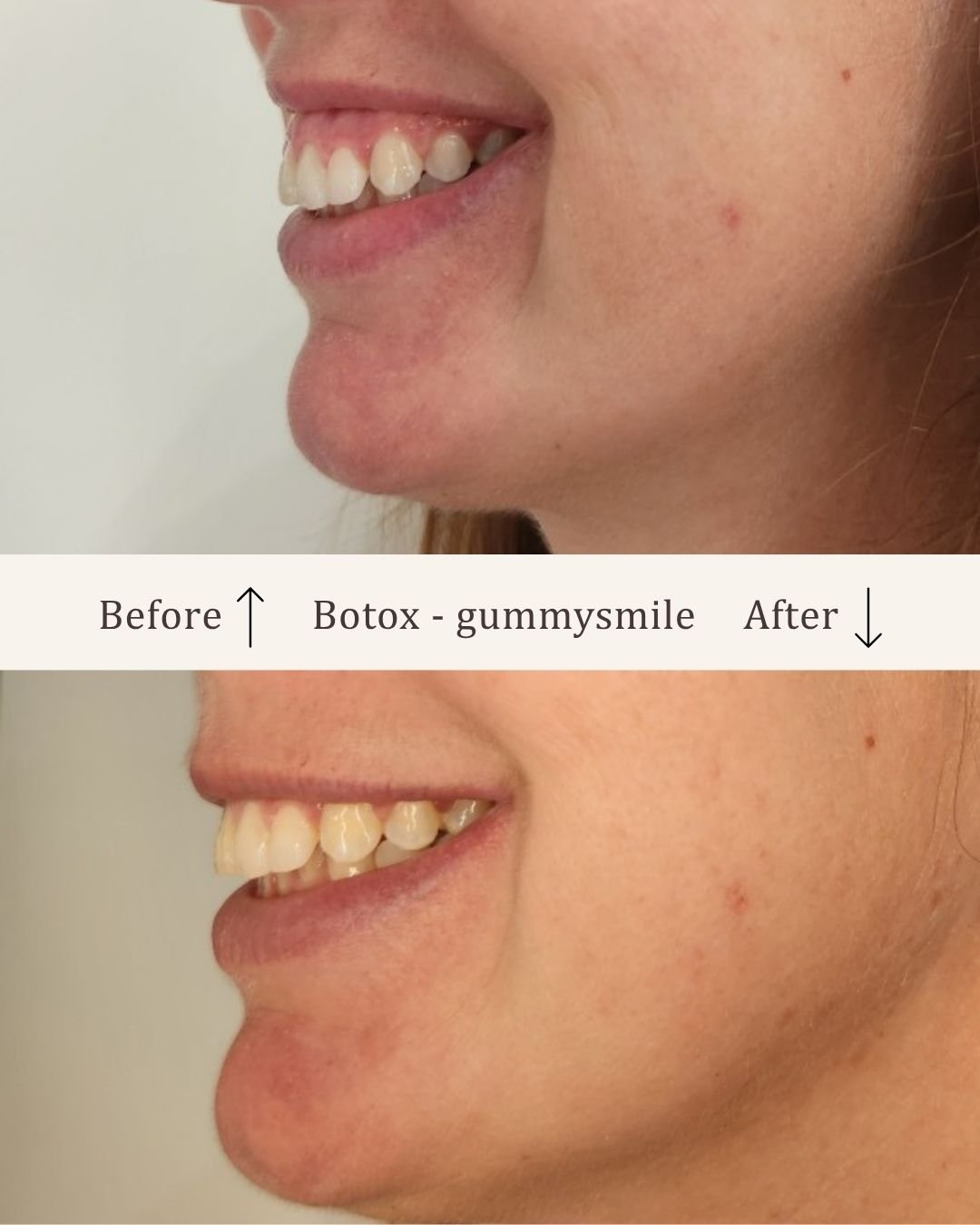 Botox-gummysmile-visage-studio-kosmetisk-klinik-odense-3.jpg