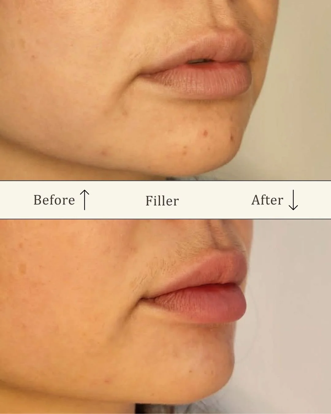 filler-laeber-odense-for-efter-visage-studio.jpg