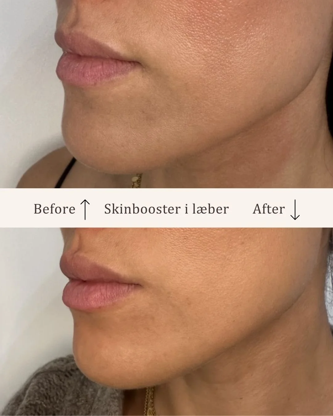 Skinbooster-læber-visage-studio-kosmetisk-klinik-odense-2.jpg
