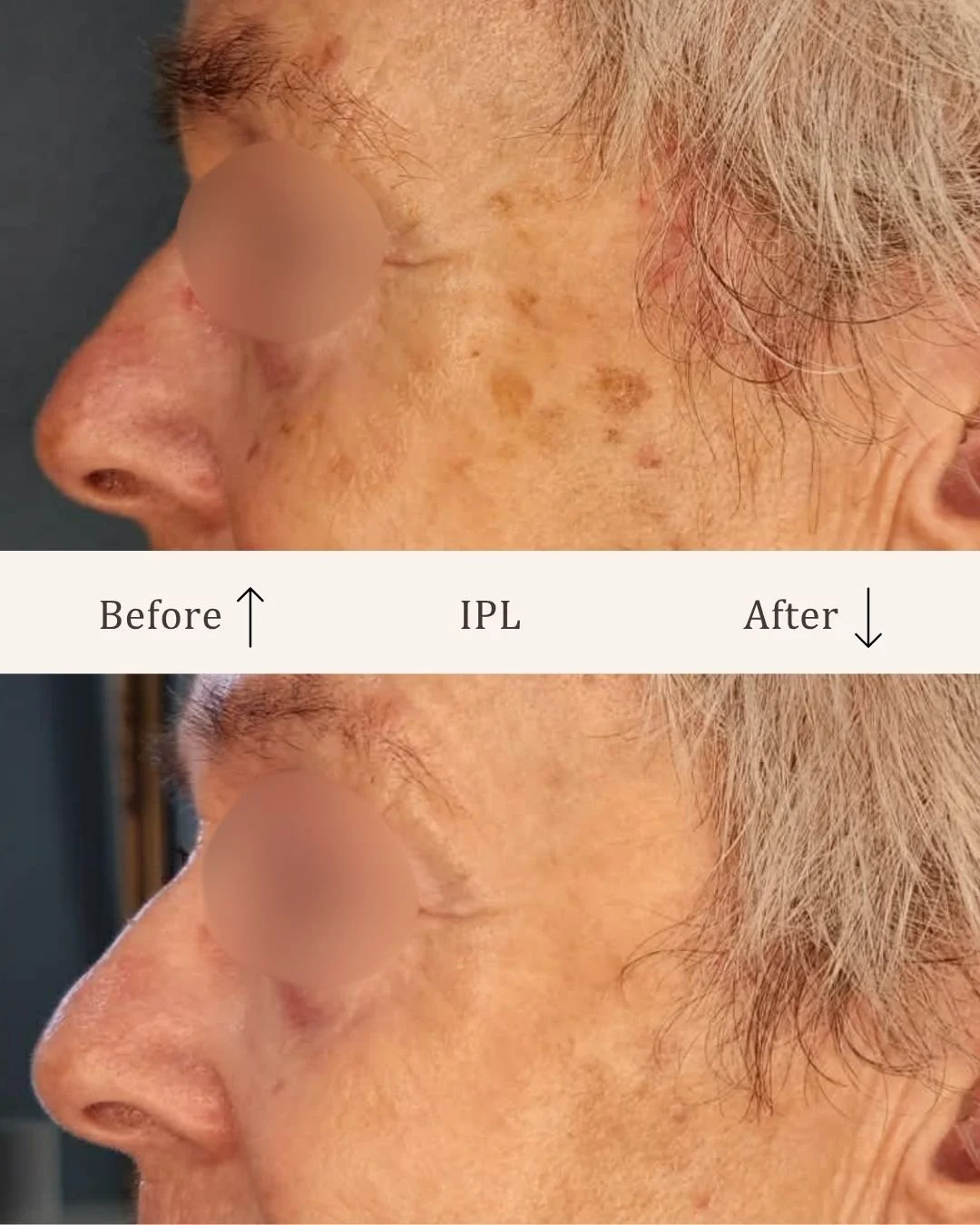 IPL-hud-foryngende-visage-studio-kosmetisk-klinik-odense.jpg