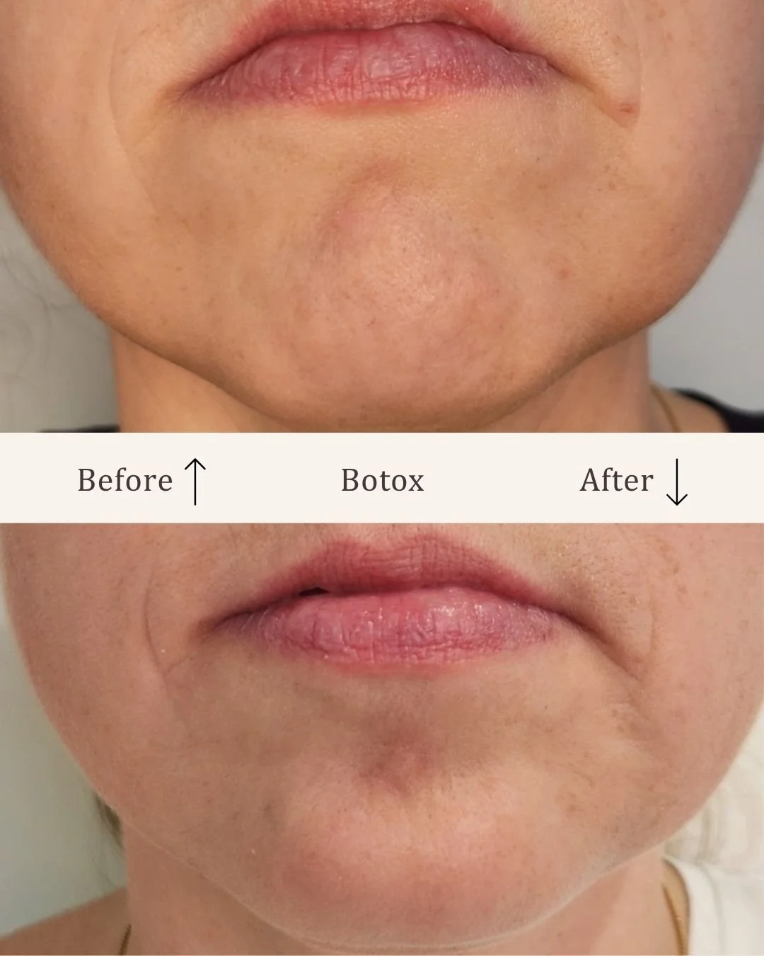 Botox-mundvige-visage-studio-kosmetisk-klinik-odense-2.jpg