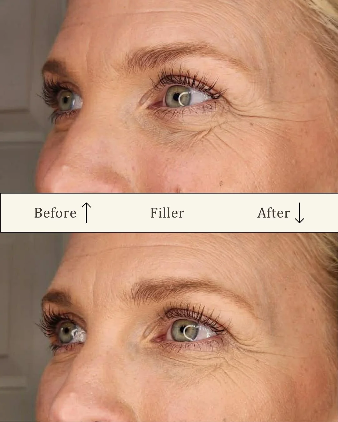 filler-under-oejnene-tear-through-odense-visage-studio.jpg