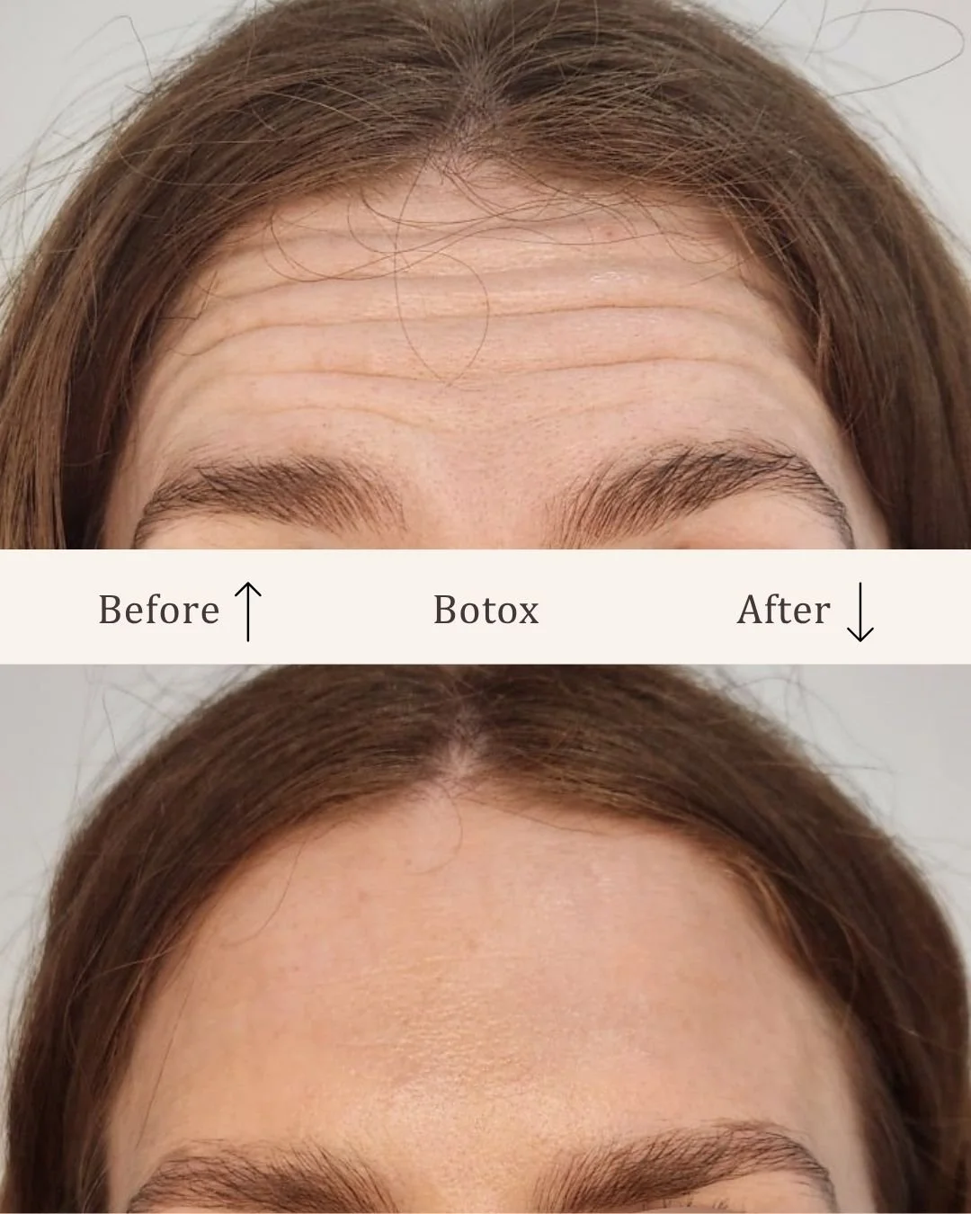 Botox-pande-visage-studio-kosmetisk-klinik-odense-2.jpg