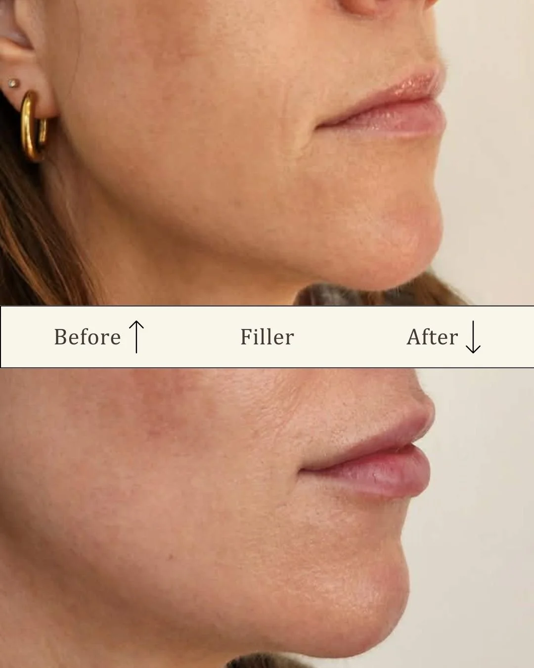 Lipfiller