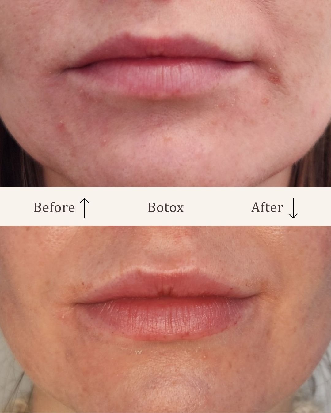 Filler-lipfiller-visage-studio-kosmetisk-klinik-odense-24.jpg