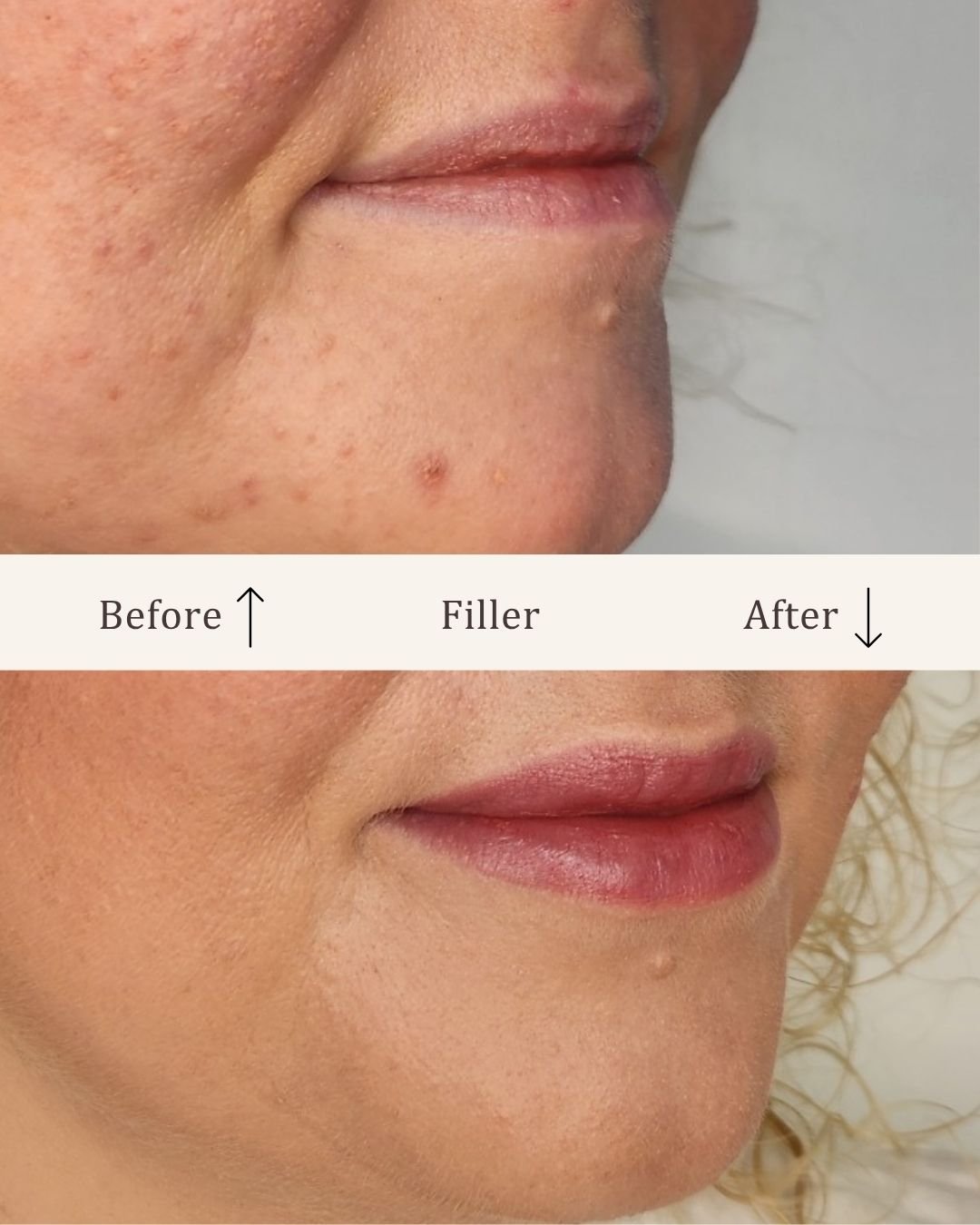 Filler-lipfiller-visage-studio-kosmetisk-klinik-odense-6.jpg