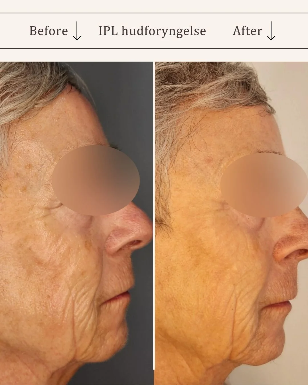 IPL-hud-foryngende-visage-studio-kosmetisk-klinik-odense-5.jpg