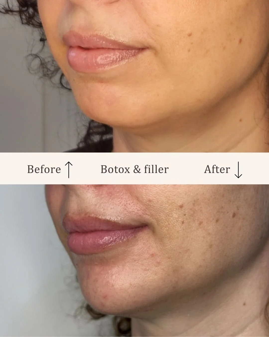 Filler-hage-visage-studio-kosmetisk-klinik-odense.jpg