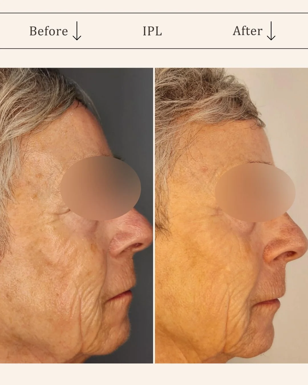 IPL foer og efter ansigt.jpg