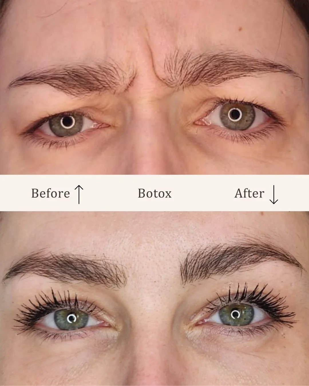 Botox-glabella-visage-studio-kosmetisk-klinik-odense-6.jpg