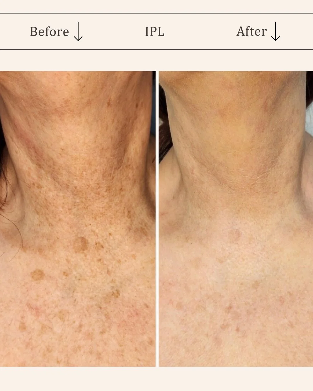 IPL-hudforyngende-hals-bryst-odense-for-efter-visage-studio.jpg