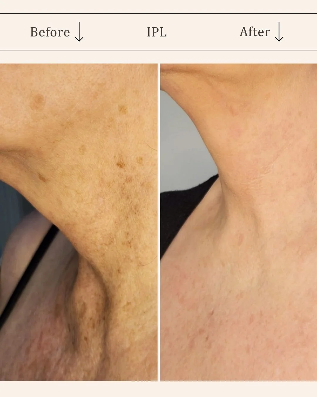IPL-hudforyngende-hals-bryst-odense-for-efter-visage-studio.jpg