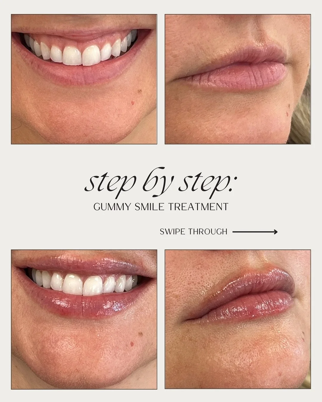 ✨ Let&rsquo;s talk gummy smiles 😁
breaking down our favorite summer before + after results🪄

Some people show a little more gum when they smile- and while it&rsquo;s totally natural, it can make you feel self-conscious. 

The good news? With just a