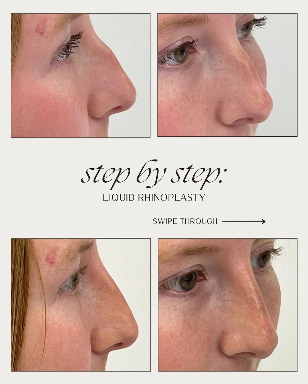 Let&rsquo;s walk through a liquid rhinoplasty ✨
This patient came in with a few concerns: a visible hump on the bridge, a tip that dipped down slightly, and a nose that leaned just a touch off-center.

Instead of changing her look, our goal was to en