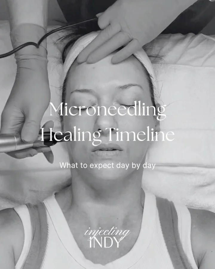 Ever wonder what really happens after microneedling? 👀
Here&rsquo;s your day-by-day breakdown - redness, glow, and all.

A little patience = major payoff🥰 Your skin rebuilds collagen for weeks after treatment, revealing smoother, tighter, more even