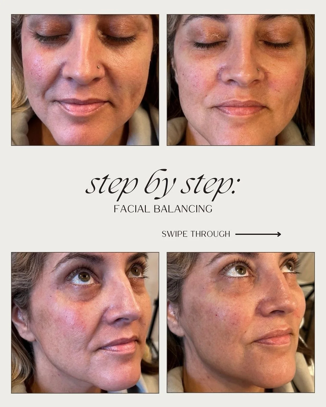 When it comes to facial balancing, it&rsquo;s not about changing your face, it&rsquo;s about bringing harmony back to your natural structure. 💫

This transformation focused on restoring volume, light, and proportion. Not overfilling.

Here&rsquo;s h