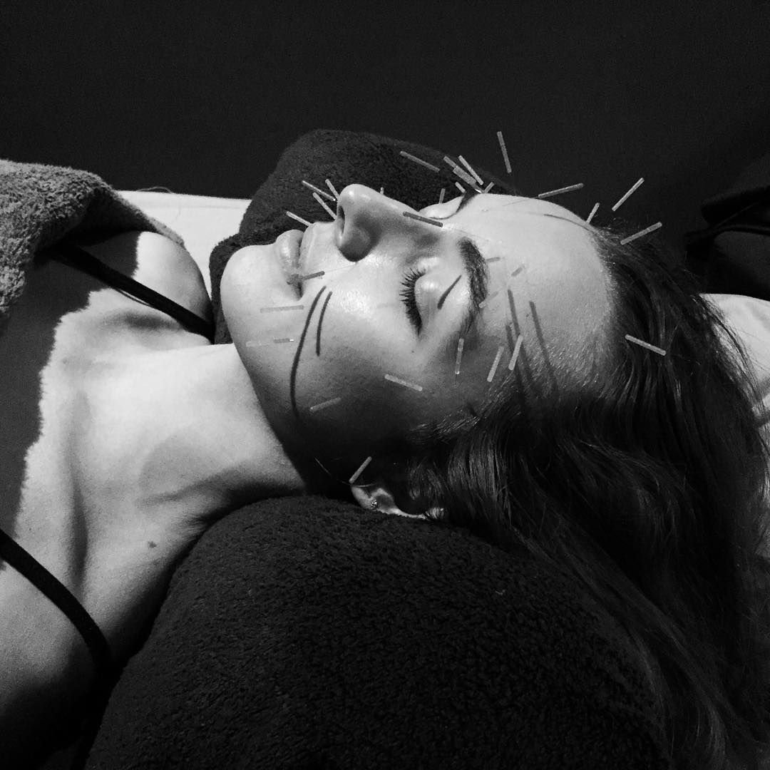 Cosmetic Acupuncture: More Than Skin Deep