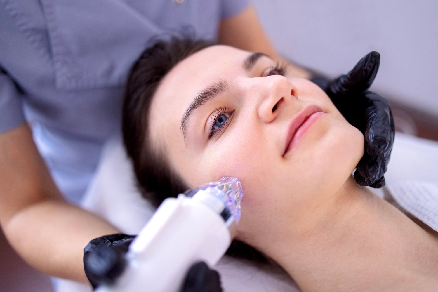 RF microneedling treatment for acne scars in Sterling, VA