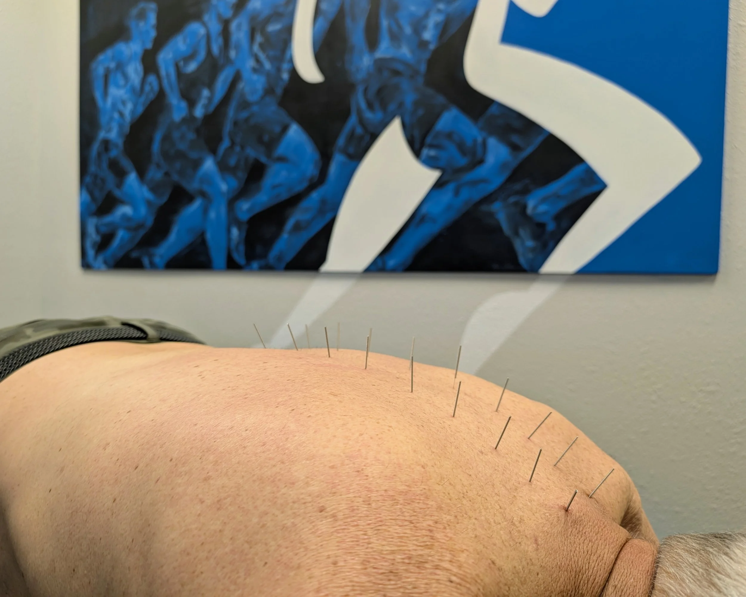 Close-up of a person lying face-up with multiple acupuncture needles inserted into their skin in an acupuncture treatment setting. A wall with modern artwork in blue and black is visible in the background.