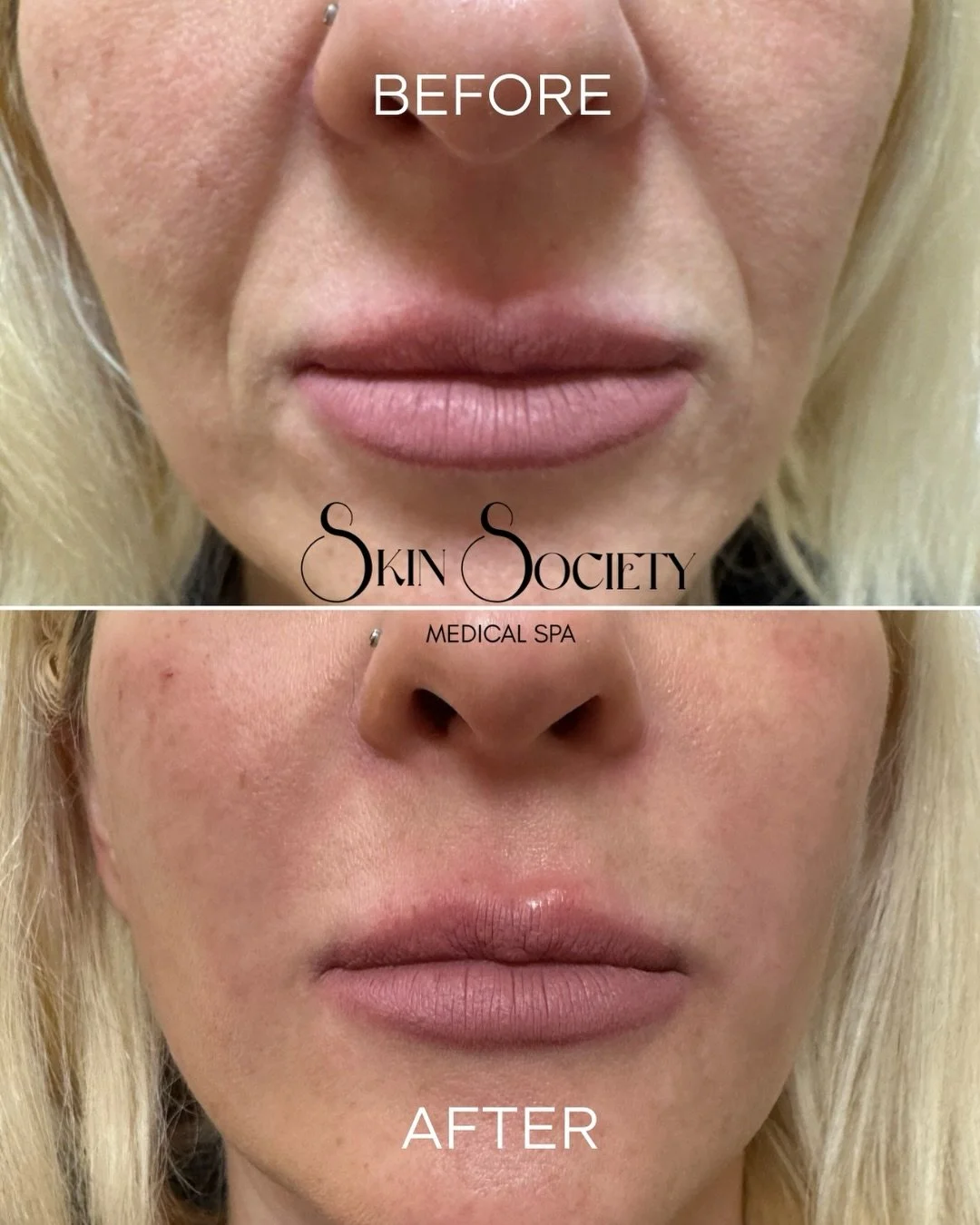 Here&rsquo;s why our clients are LOVING nasolabial folds filler &amp; mid-face filler at Skin Society Medical Spa 🫧

&bull; reduces deep smile line appearance
&bull; adds volume and plumpness to the area 
&bull; gives a refreshed look 
&bull; reduce