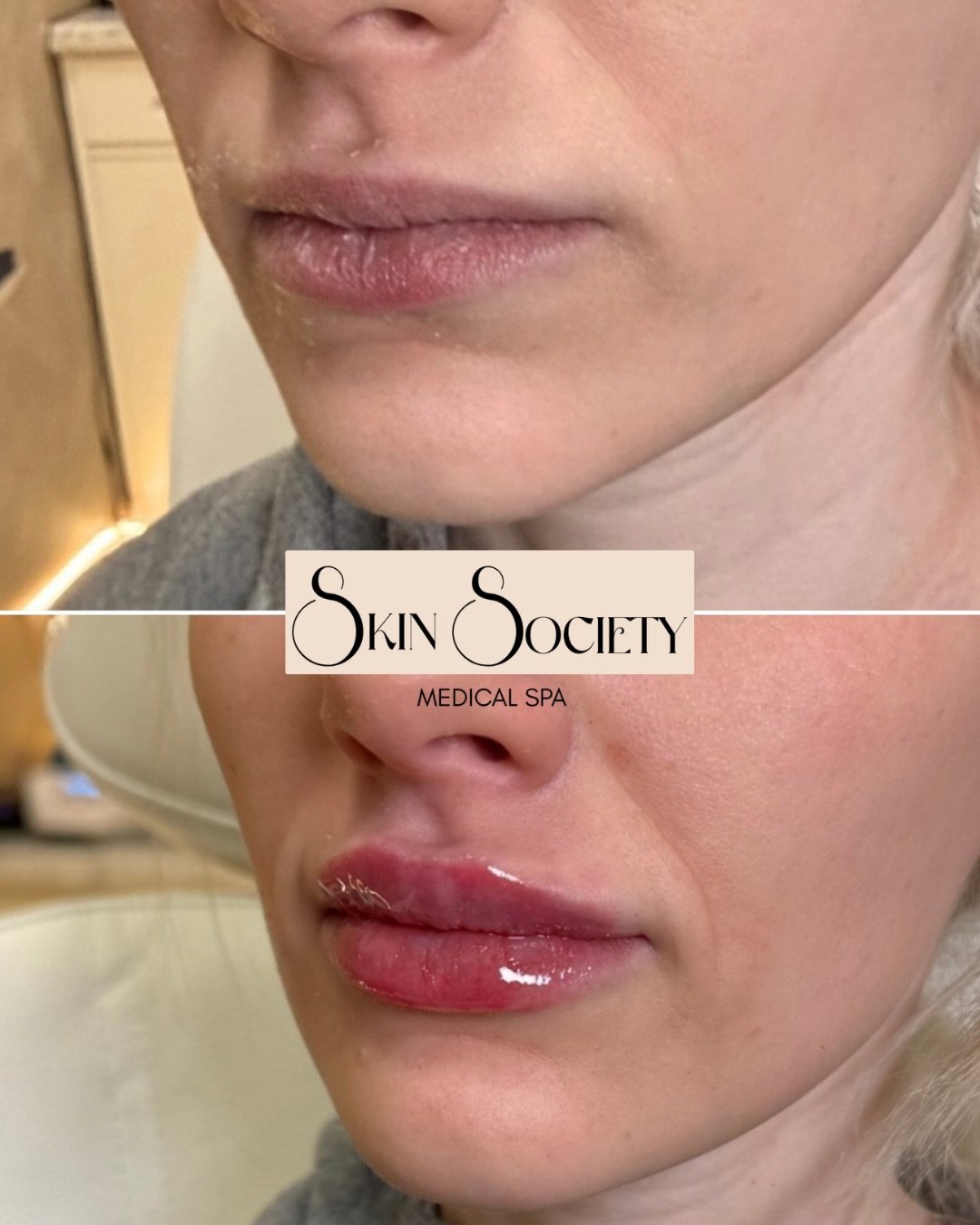 We heard the pout is what you want&hellip; 👀 @marwajayy_aesthetics has you covered for a juicy lip that enhances your natural look- never erasing it. Book an appointment for lip-filler on our website today 💋✨