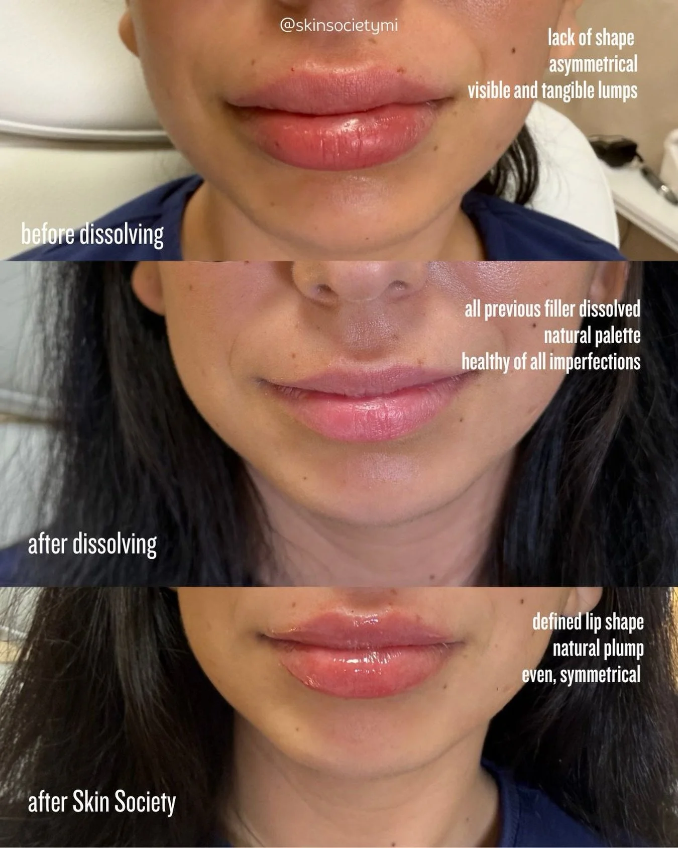 The ultimate lip fix at Skin Society located in Canton, MI! Our client presented with poorly-performed lip filler [not by our injectors] and wanted to start her lip filler journey from scratch. We safely and professionally dissolved her lips and gave