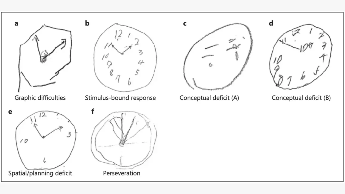 schizophrenia-clock-drawing-test-body.webp