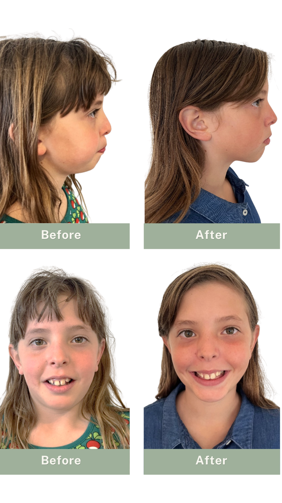 Before and after head shots of child showing results of myofunctional theray