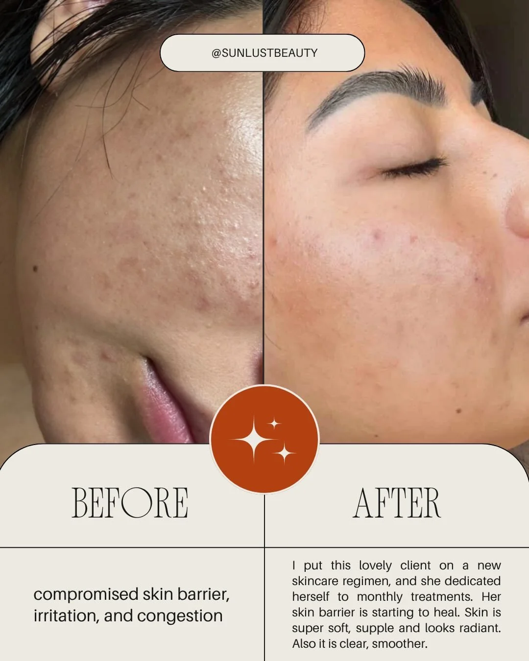 So so proud of this client! Her consistency is what got her these results 🤩🤏🏽 I&rsquo;m so happy for her ✨🪷🫶🏼 

Our monthly treatments made progress, but home care really moved the needle 🌱

All homecare used is @circadia
Nourish cream cleanse