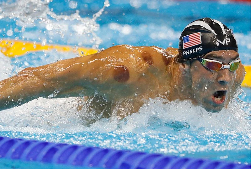Olympic Swimmer Michael Phelps showing visible marks of Cupping therapy