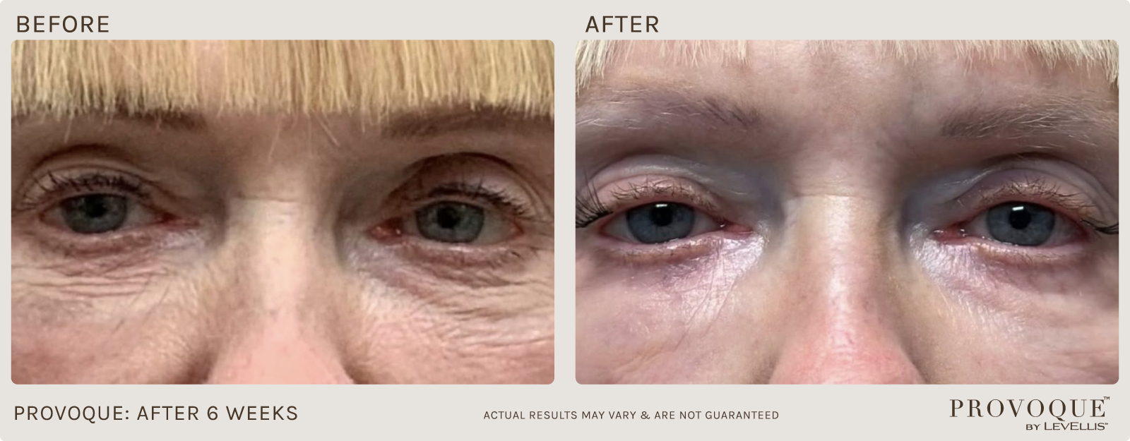 Provoque results after 6 weeks. 